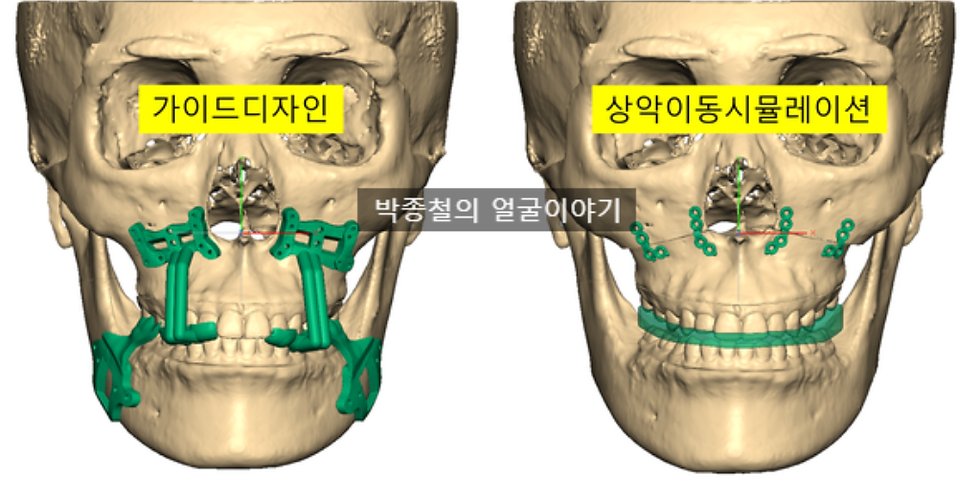 이미지 설명: 계획된 위치에 정확히 고정될 수 있도록 제작된 환자 맞춤형 금속판과, 이를 안내하는 수술 가이드용 스크류홀입니다.