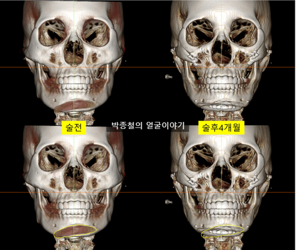 [이미지 설명] 비대칭적으로 위치했던 노란 선의 무턱 보형물이 제거되고, T-절골을 통한 무턱수술로 턱끝이 정확하게 중앙에 위치하여 대칭을 이룬 무턱수술전후 모습입니다.
