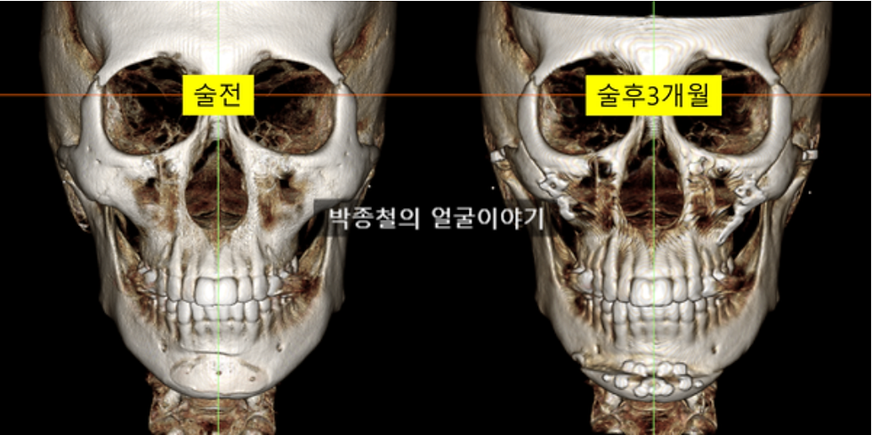 턱끝 수술 3개월 후 CT
