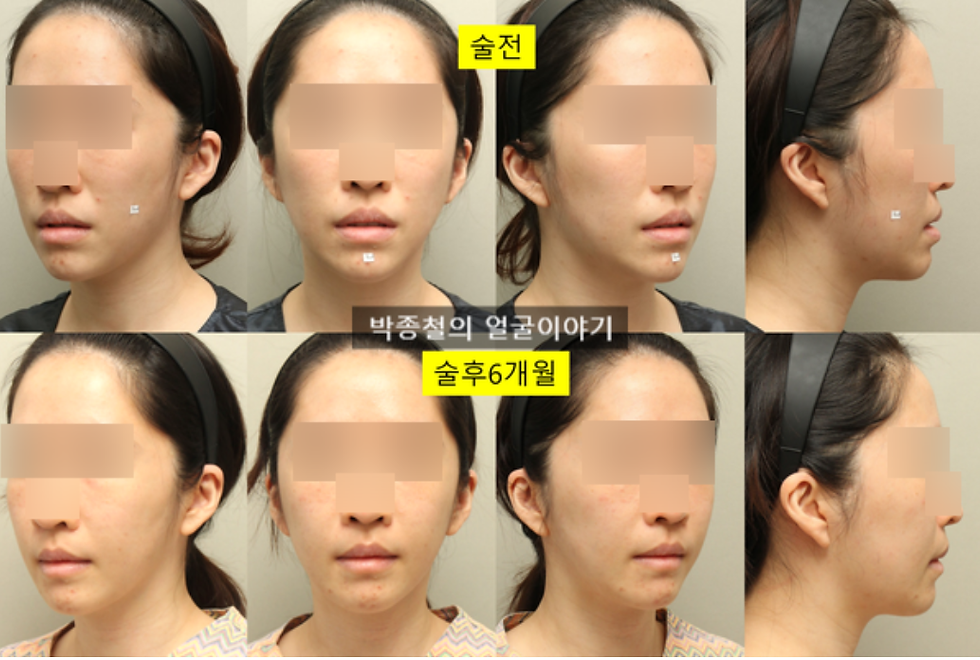 양악수술 전후 6개월 임상 사진 비교