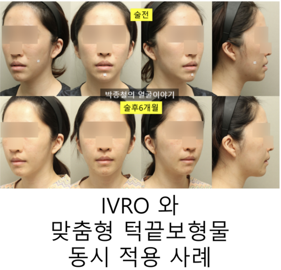 양악수술전후 6개월, 거미스마일 개선과 맞춤형 턱끝보형물 적용 사례
