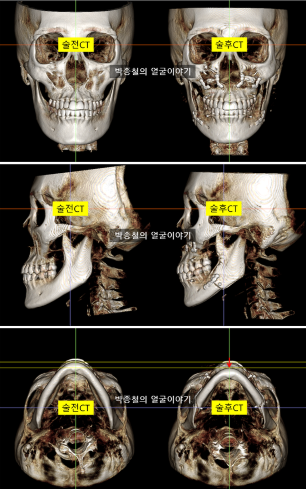이미지 : 양악수술 전후 3D CT 비교 사진 수술을 통해 돌출되었던 아래턱이 이상적인 위치로 이동하고, 얼굴 전체의 균형이 바로잡힌 모습을 입체적인 3D CT 이미지로 확인할 수 있습니다.