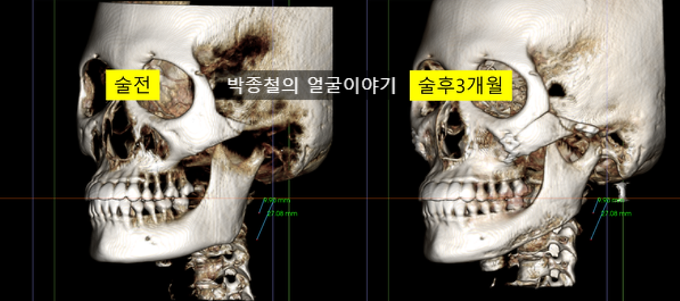 이미지 설명: 수술 후 CT 사진입니다. 45도에서 부드럽게 형성된 턱선을 확인할 수 있습니다.