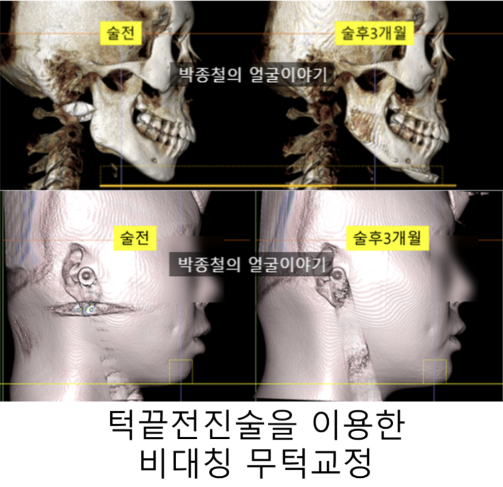 턱끝전진술, 비대칭 무턱의 효과적인 해법 (구강악안면외과 전문의가 CT로 증명)