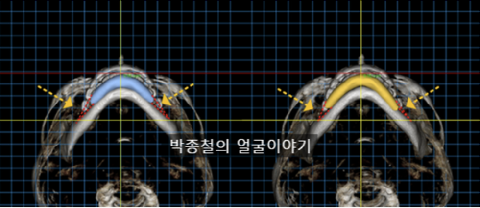 턱끝전진술에 의한 단차