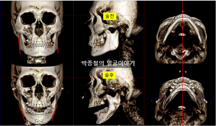 남자 윤곽 3종 술후 ct사진