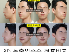 3D 돌출입수술 방법: 수술과 교정, 어떤 방법이 더 좋을까? 돌출입수술1년 전후비교
