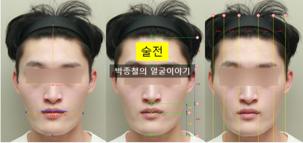 얼굴이 길다고 느끼셨던 주된 이유는 ‘짧은 인중’ 때문