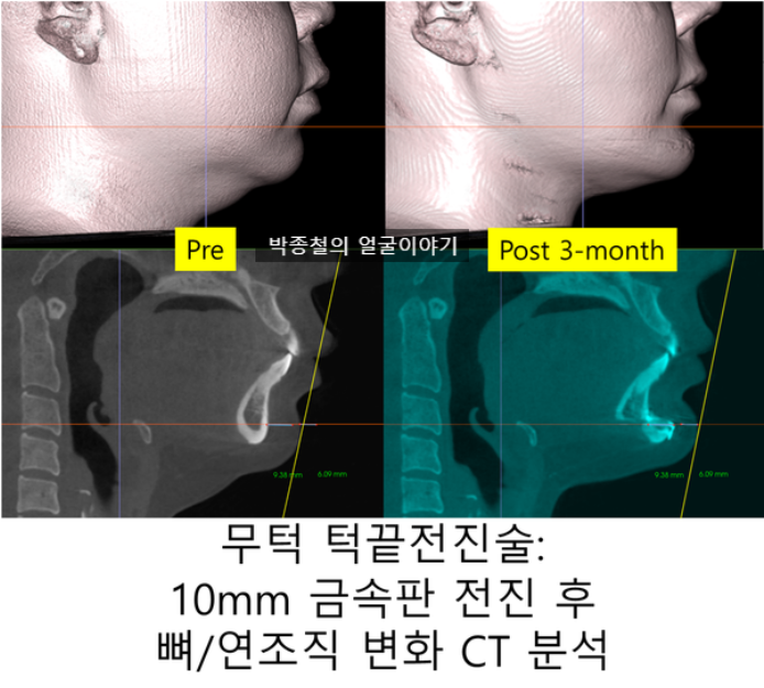 턱끝전진술 10mm 전진 후 뼈와 연조직 변화 분석