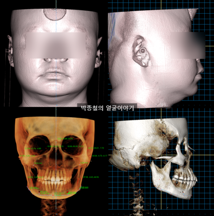 술전 분석: 무턱, 비대칭, 돌출입을 동반한 케이스