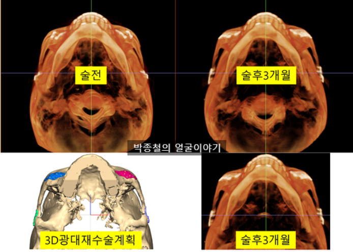 3D 광대 재수술 술후 CT 평가