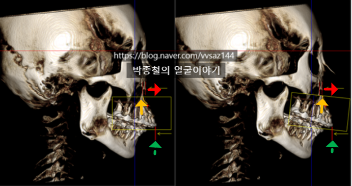 顎矯正手術中のウェーハと歯の位置のわずかなずれが、骨の再配置に大きな不正確さを招く可能性があることを示す図の画像