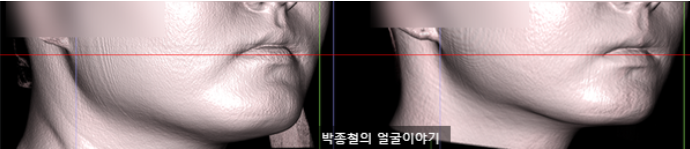 사각턱수술 없이 시행한 양악수술 술후 사각턱 라인
