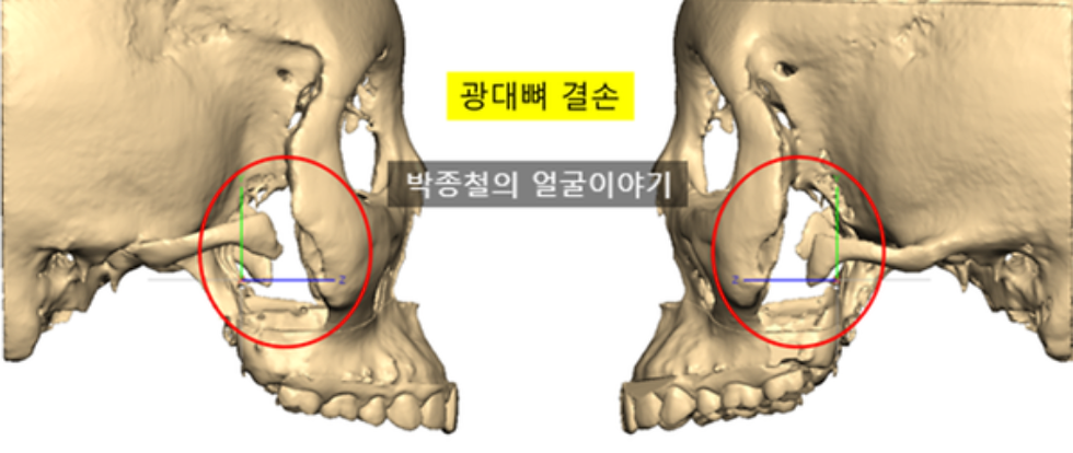 광대재수술이 필요한 골결손 이미지