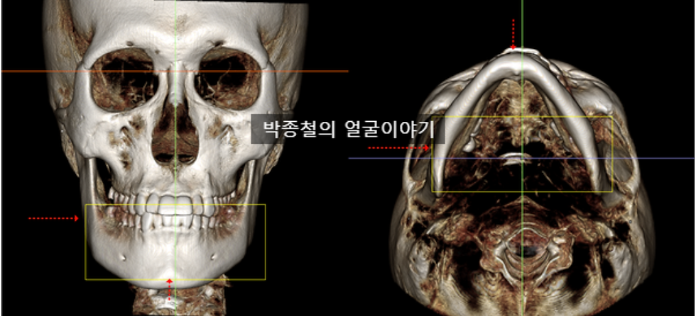 이미지 설명: 술전 3D CT 정면 이미지 – 우측 사각턱(사진상 왼쪽)이 바깥쪽으로 더 발달하고, 턱끝이 우측으로 틀어져 있어 전체적인 안면비대칭의 원인이 되고 있음을 확인할 수 있습니다.