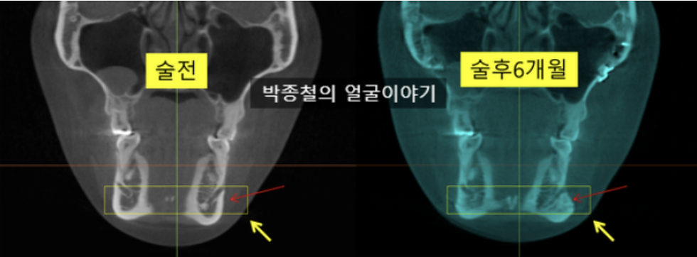 무턱 수술 후 연조직 볼륨 증가 확인