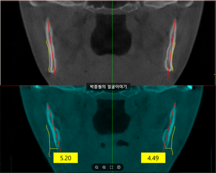 양악수술만으로도 사각턱이 줄어드는 이유
