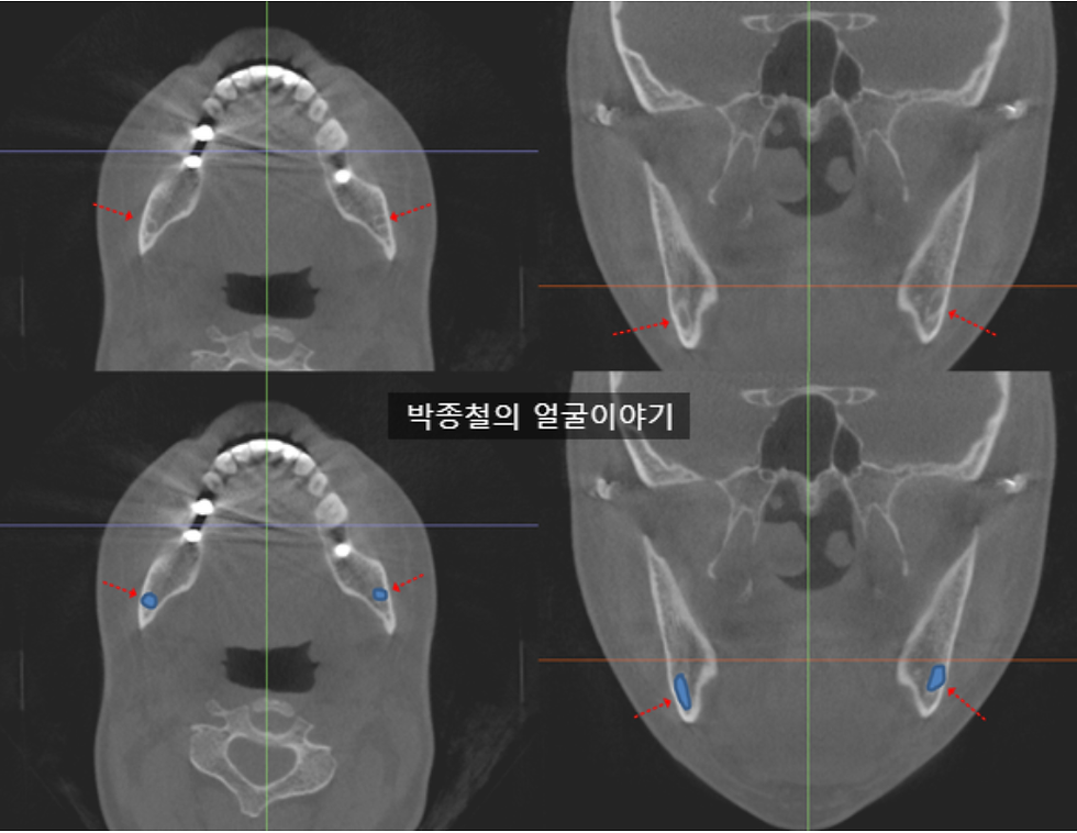 양악수술방법 중 ivro 를 선택하는 경우 : 신경관과 피질골이 근접한 경우