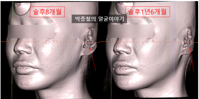 광대 고랑 변화 비교 사진