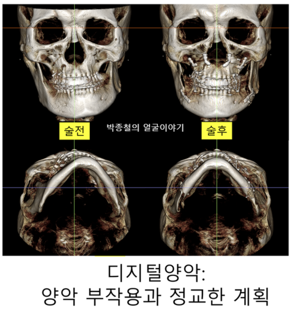 양악수술부작용, 3D 디지털양악의 정교한 계획으로 예방합니다