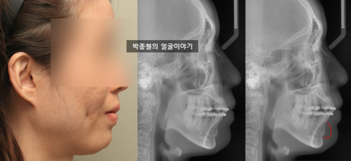 보형물 시술 후 어색한 입매