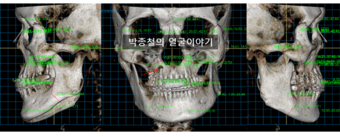 양악 수술 절골선 디자인 시 고려 사항