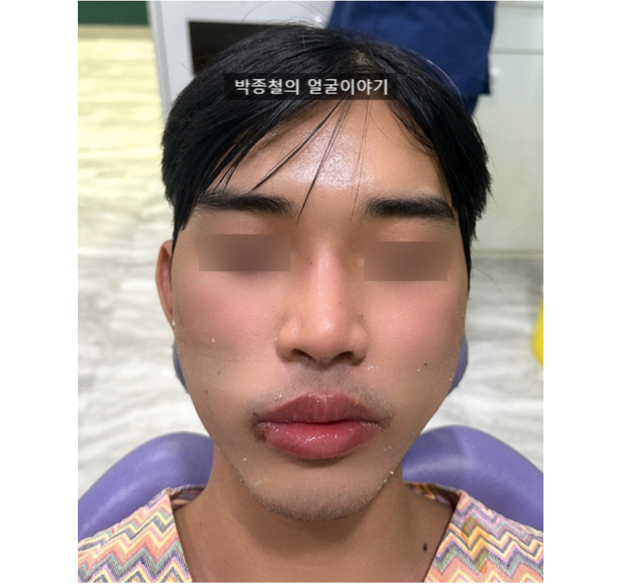 Patient appearance on discharge day following corrective jaw surgery