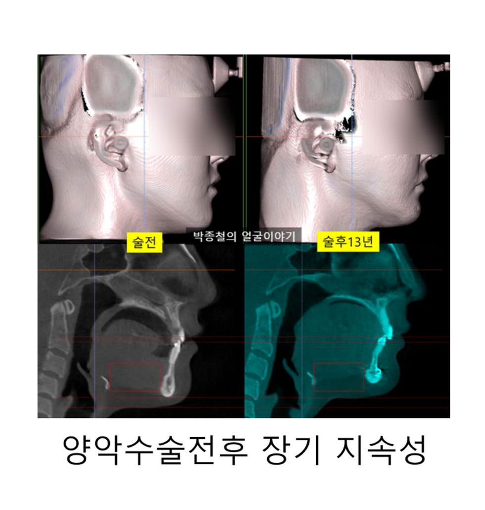 10년 뒤 양악수술후기, CT로 검증한 양악수술전후 장기 지속성