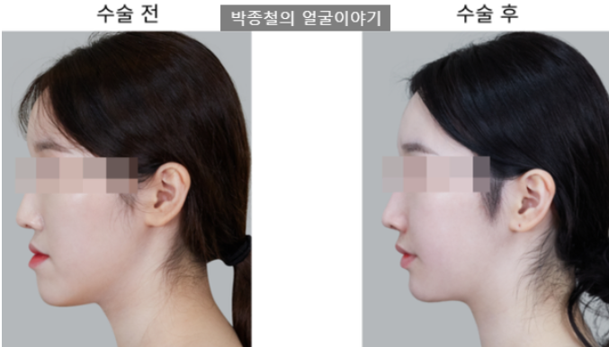 양악수술로 턱밑살 처짐 예방효과
