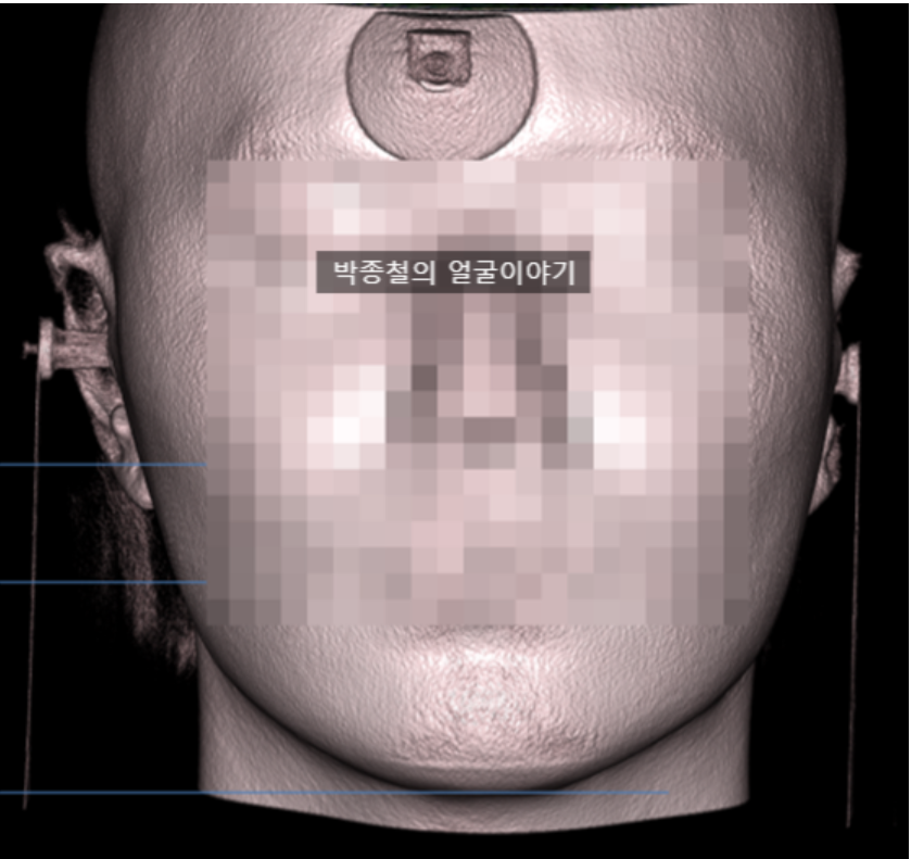 발달된 광대뼈 부위