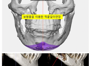 Introduction to Chin Length Restoration Methods: Can I get a prosthesis after chin surgery?