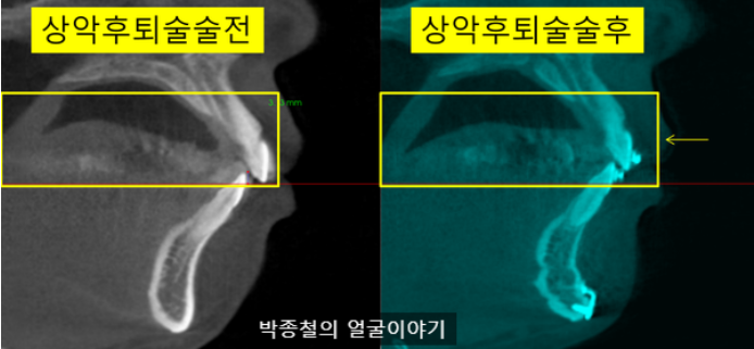 코 주변부 골격이 '후퇴'하거나 '변화가 거의 없는' 경우