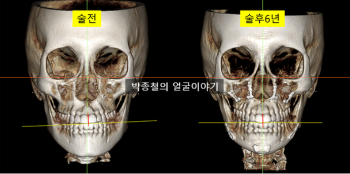 비대칭양악수술 6년 경과후기