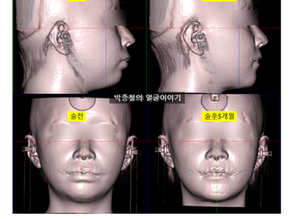무턱 양악수술후기·전후: 주걱턱 양악수술과 다른 이유와 핵심 고려사항 3가지