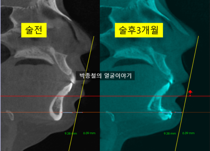 턱끝전진술 10mm 전진 후 뼈와 연조직 변화 분석