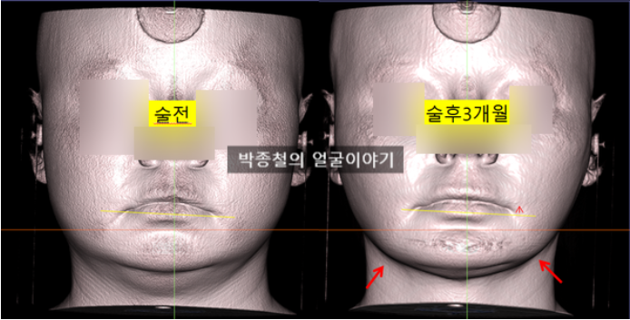 턱끝전진술 후 연조직 볼륨 변화
