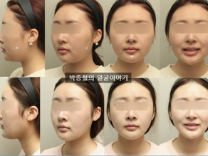 무턱수술 후기: 자가골 무턱절골술로 드라마틱한 변화! (전후사진有)