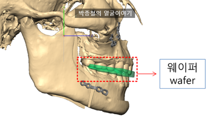 양악수술웨이퍼 (wafer)