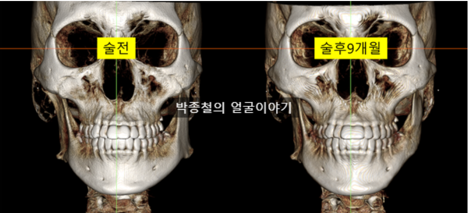 사각턱수술전후 비교: 9개월