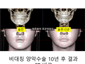 양악수술병원추천, 10년 후 CT 결과로 증명하는 '지속성'