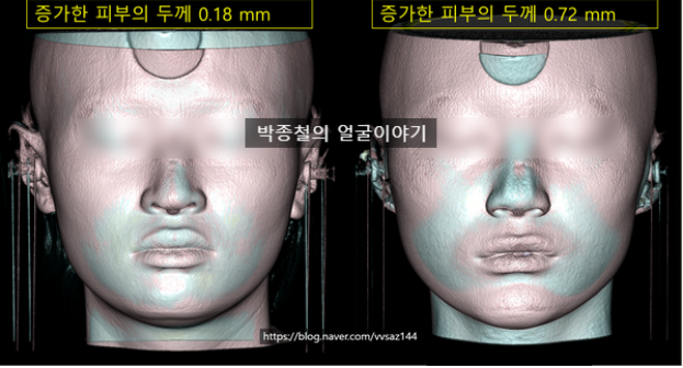 광대축소술 후 코 주변부가 두꺼워지는 연조직 재배치