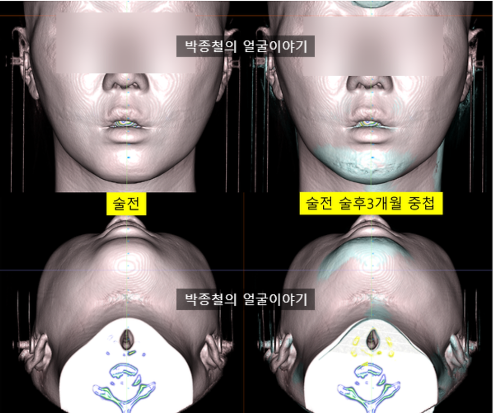 턱끝 수술 3개월 후 연조직 CT 측면이미지