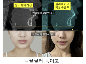 턱끝필러 녹이고 수술하면 어떻게 될까? (무턱필러 부작용과 골침식 CT 분석)