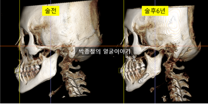 미용양악수술 6년 경과후기