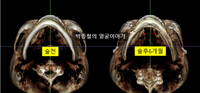 좌우 차등 전진량 적용으로 무턱 비대칭 개선