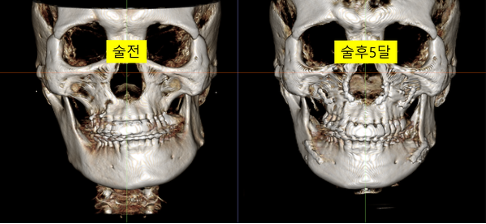이미지 설명: 수술 전과 수술 후 5개월 경과 시점의 3D CT 사진입니다. 계획대로 비대칭이 개선되었음을 확인할 수 있습니다.