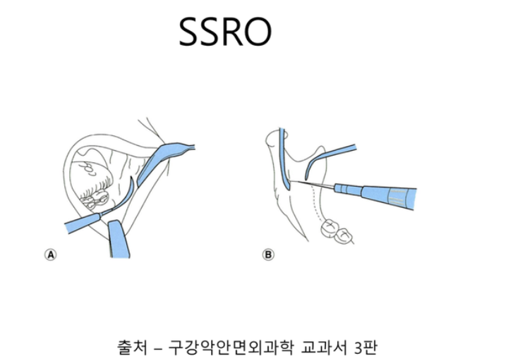 Sagittal Split Ramus Osteotomy (SSRO)
