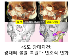 성공적인 45도 광대재건, 핵심은 3차원적 위치 복원입니다