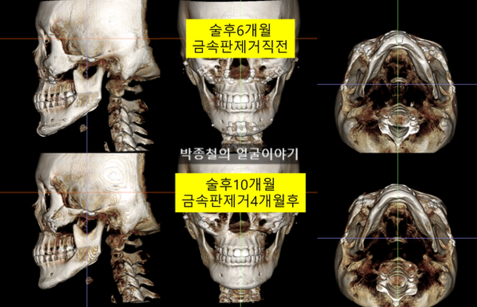 금속판을 제거하는 안면윤곽 핀제거 수술