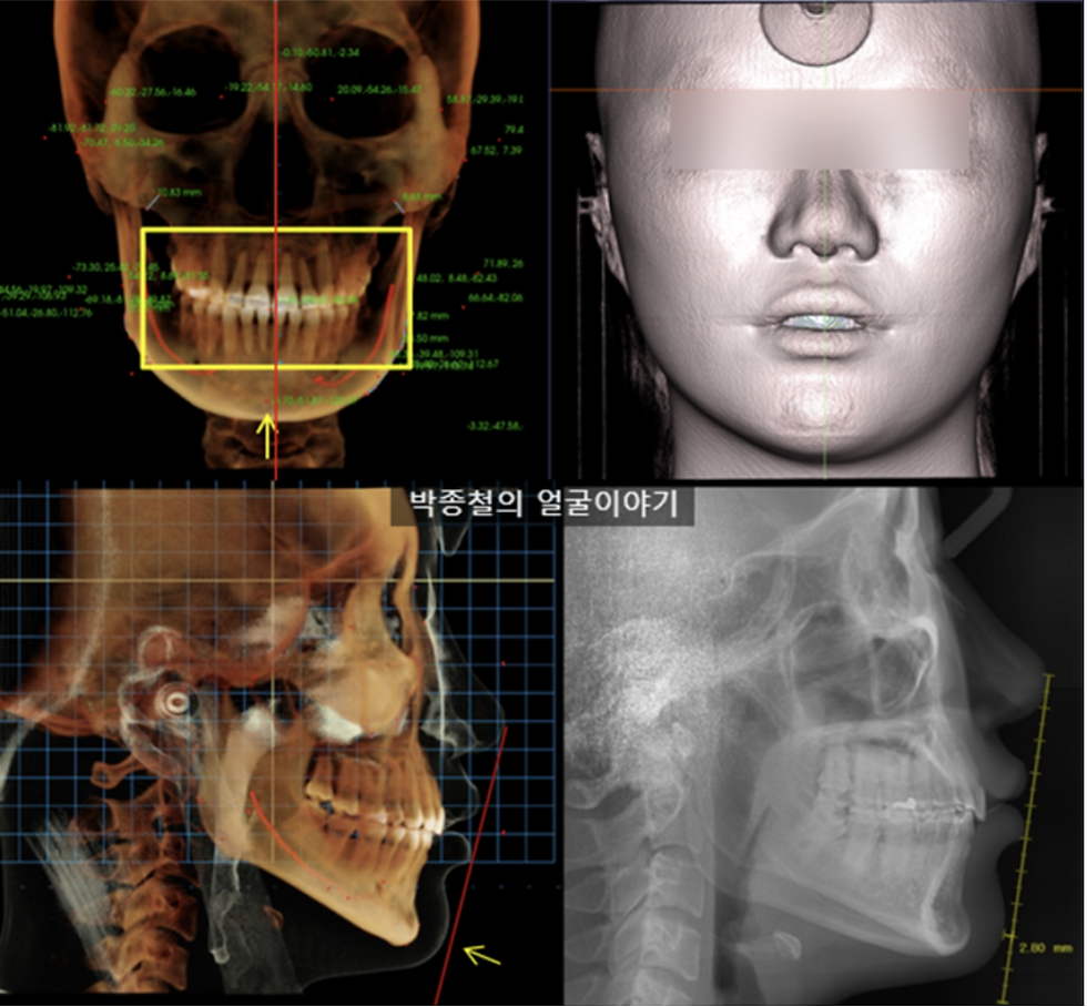 무턱과 비대칭이 동반된 경우